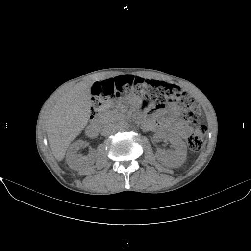 File:Air bronchogram in pneumonia (Radiopaedia 85719-101512 Axial non-contrast 81).jpg