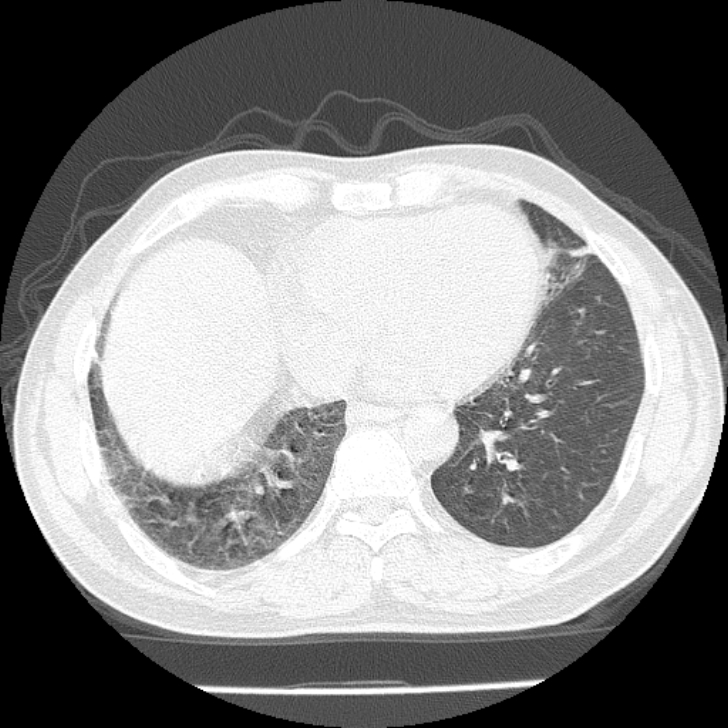 Airway foreign body in adult (Radiopaedia 85907-101779 Axial lung window 133).jpg