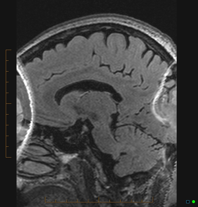 Aliasing artifact causing a spurious cerebellar lesion (Radiopaedia 48783-53810 Sagittal FLAIR 27).jpg