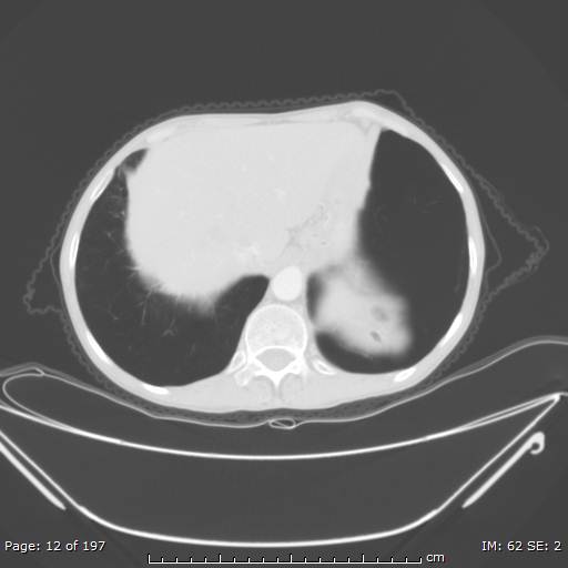Alpha-1-antitrypsin deficiency (Radiopaedia 50561-55987 Axial lung window 6).jpg