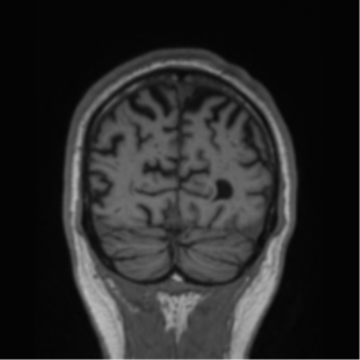 Alzheimer's disease- with Gerstmann syndrome and dressing apraxia (Radiopaedia 54882-61150 Coronal T1 17).png