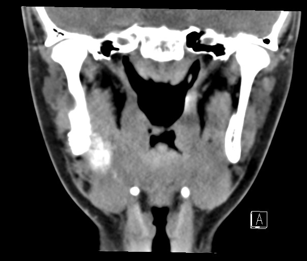 File:Ameloblastoma (Radiopaedia 26645-26793 Coronal C+ delayed 12).jpg