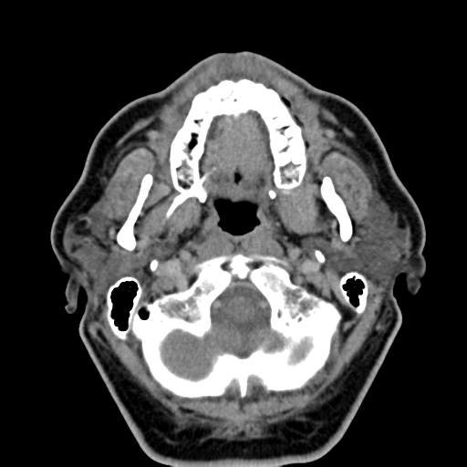 Ameloblastoma (Radiopaedia 38520-40623 Axial non-contrast 21).png