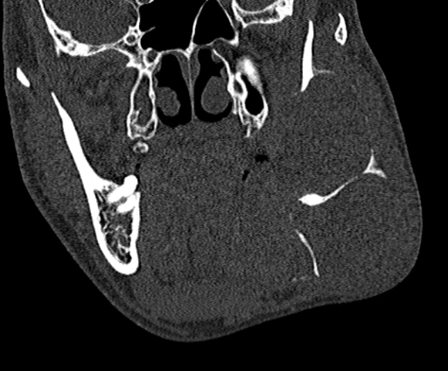 Ameloblastoma (Radiopaedia 51921-57766 Coronal bone window 116).jpg
