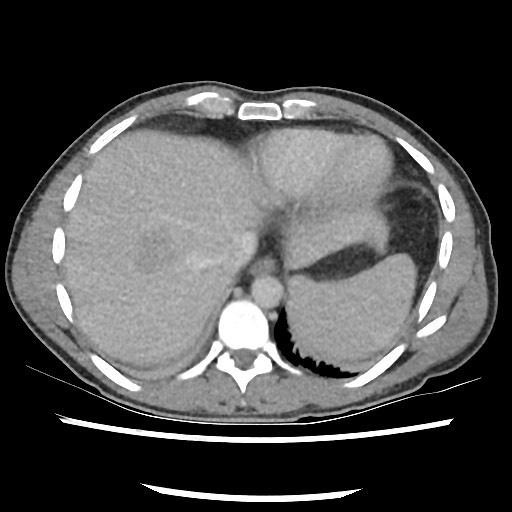 Amoebic liver abscesses (Radiopaedia 55536-62010 A 13).jpg