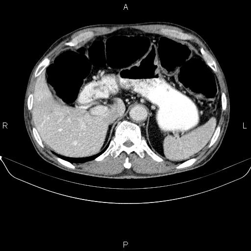 File:Ampullary adenocarcinoma (Radiopaedia 86093-102032 A 16).jpg