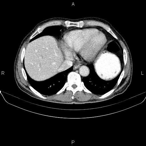 Ampullary adenocarcinoma (Radiopaedia 86093-102032 A 8).jpg