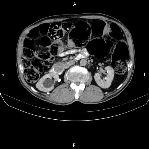 Ampullary adenocarcinoma (Radiopaedia 86093-102032 Axial C+ delayed 44).jpg