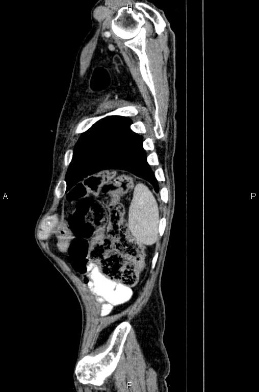 Ampullary adenocarcinoma (Radiopaedia 86093-102033 E 84).jpg