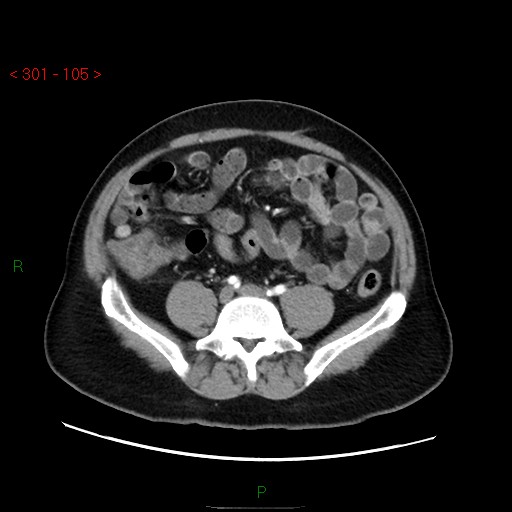 File:Ampullary carcinoma (Radiopaedia 56396-63056 B 51).jpg