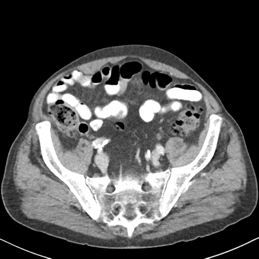 File:Amyand hernia (Radiopaedia 39300-41547 A 54).png
