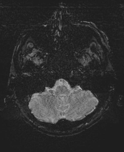 Amyloid angiopathy with inflammation (Radiopaedia 30360-31002 Axial SWI 2).jpg