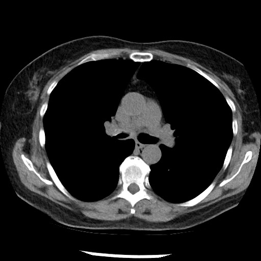 File:Amyloidosis - bronchial and diffuse nodular pulmonary involvement (Radiopaedia 60156-67744 Axial non-contrast 25).jpg