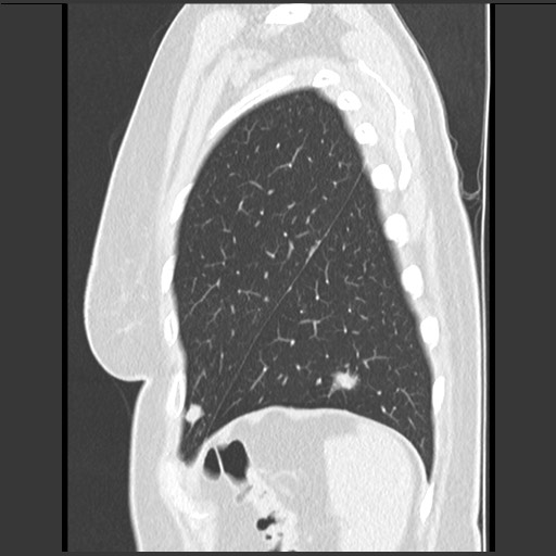 Amyloidosis - bronchial and diffuse nodular pulmonary involvement (Radiopaedia 60156-67744 F 48).jpg