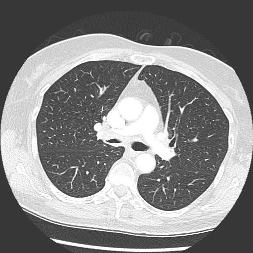 Amyloidosis - bronchial and diffuse nodular pulmonary involvement (Radiopaedia 60156-67745 Axial lung window 33).jpg