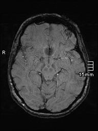 Amyotrophic lateral sclerosis (Radiopaedia 70821-81017 Axial SWI 20).jpg