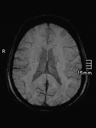 File:Amyotrophic lateral sclerosis (Radiopaedia 70821-81017 Axial SWI minIP 29).jpg