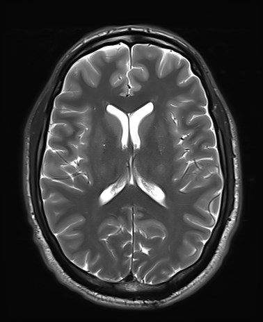 File:Amyotrophic lateral sclerosis (Radiopaedia 87352-103658 Axial T2 16).jpg