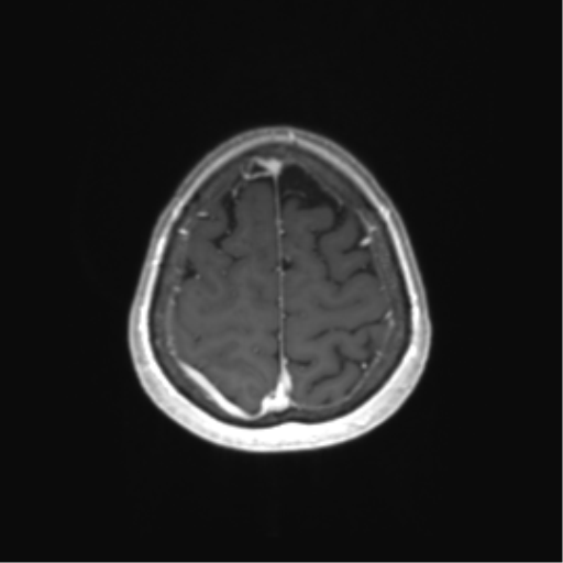 File:Anaplastic astrocytoma (Radiopaedia 86943-103160 Axial T1 C+ 76).png
