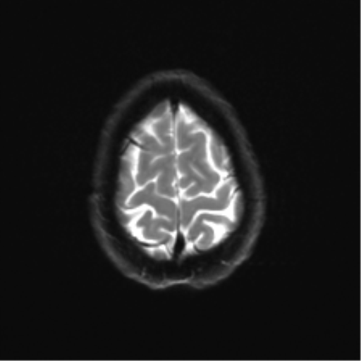 Anaplastic astrocytoma IDH mutant (Radiopaedia 50046-55341 Axial DWI 25).png