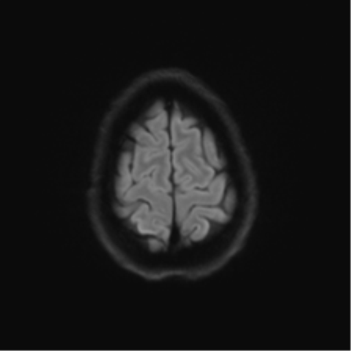 Anaplastic astrocytoma IDH mutant (Radiopaedia 50046-55341 Axial DWI 52).png