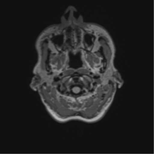 File:Anaplastic astrocytoma IDH mutant (Radiopaedia 50046-55341 Axial FLAIR 3).png