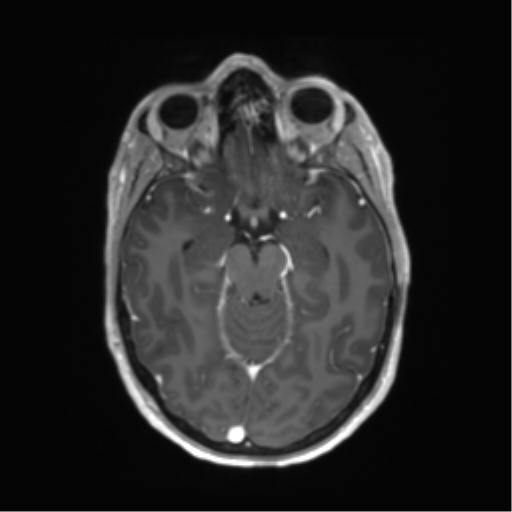 File:Anaplastic astrocytoma IDH mutant (Radiopaedia 50046-55341 Axial T1 C+ 20).png