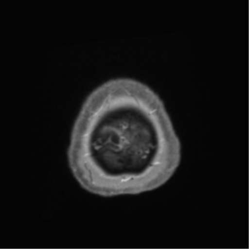 Anaplastic astrocytoma IDH wild-type (pseudoprogression) (Radiopaedia 42209-45278 Axial T1 C+ 149).png