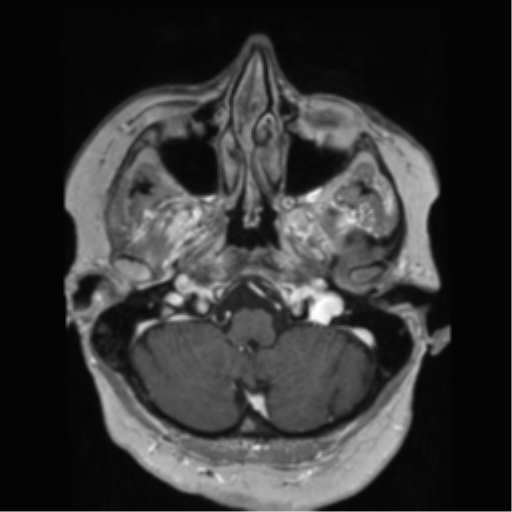 File:Anaplastic astrocytoma IDH wild-type (pseudoprogression) (Radiopaedia 42209-45278 Axial T1 C+ 36).png