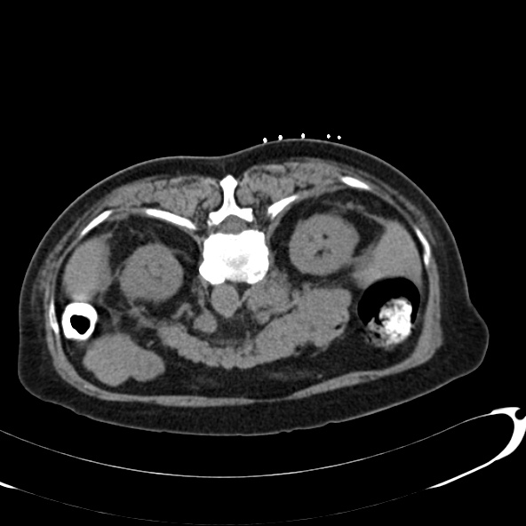 File:Anaplastic lymphoma - with CT biopsy (Radiopaedia 21643-21602 Axial non-contrast 18).jpg
