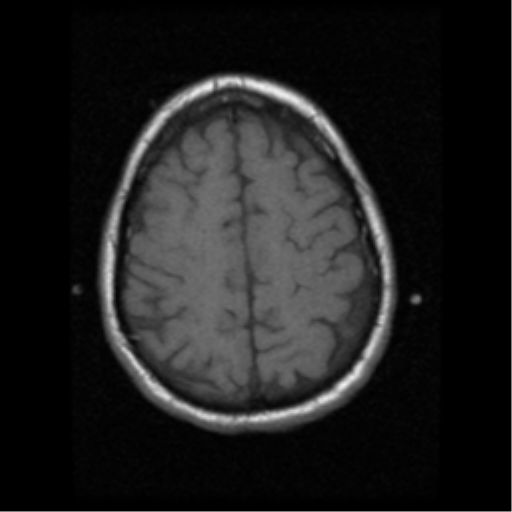File:Anaplastic meningioma with recurrence (Radiopaedia 34452-35783 Axial T1 17).png