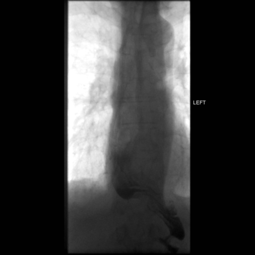 File:Anastomotic stricture post Ivor Lewis esophagectomy (Radiopaedia 47937-52715 C 11).png