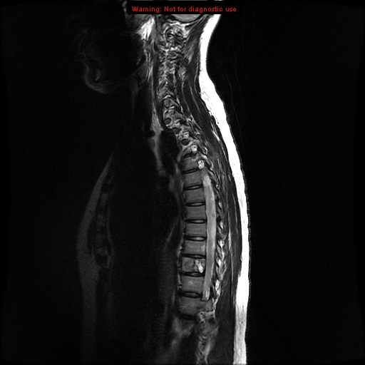 File:Aneurysmal bone cyst (Radiopaedia 9419-10103 G 2).jpg
