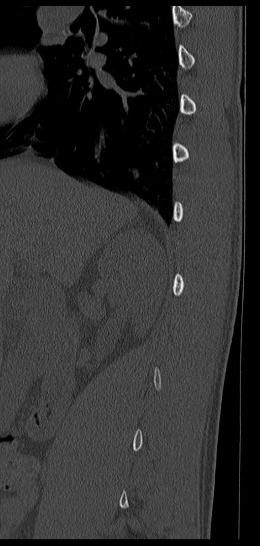 Aneurysmal bone cyst T11 (Radiopaedia 29294-29721 Sagittal bone window 65).jpg