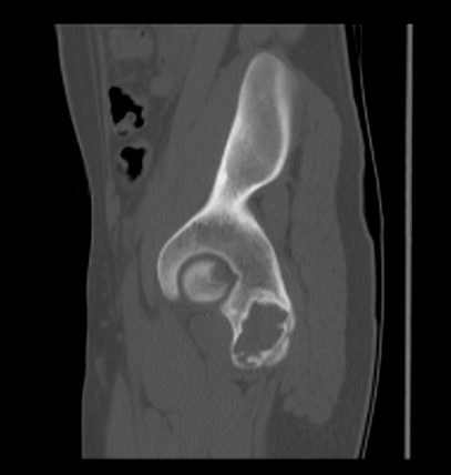 Aneurysmal bone cyst of ischium (Radiopaedia 25957-26094 Sagittal bone window 53).png