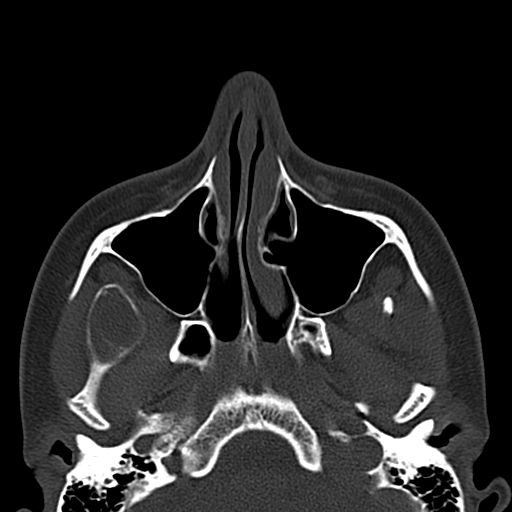 File:Aneurysmal bone cyst of the mandible (Radiopaedia 43280-46601 Axial bone window 71).jpg