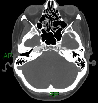 File:Aneurysmal subarachnoid hemorrhage with intra-axial extension (Radiopaedia 84371-99732 A 41).jpg
