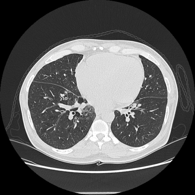 Angioinvasive aspergellosis (Radiopaedia 66995-76315 Axial lung window 33).jpg