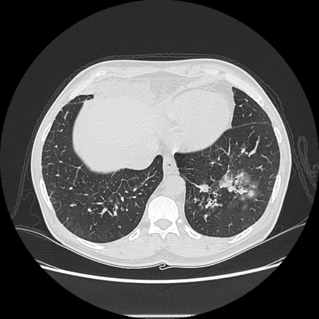 Angioinvasive aspergellosis (Radiopaedia 66995-76315 Axial lung window 41).jpg