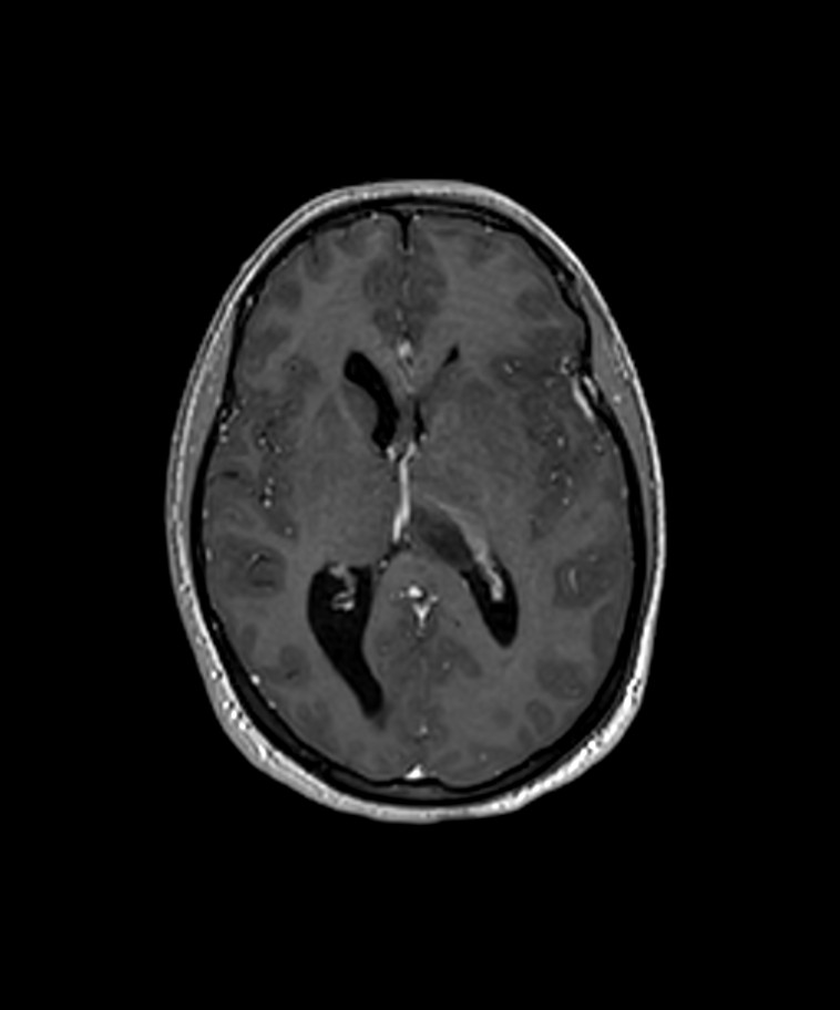Angiomatous meningioma (Radiopaedia 79459-92577 Axial T1 C+ 3D ISO 3).jpg