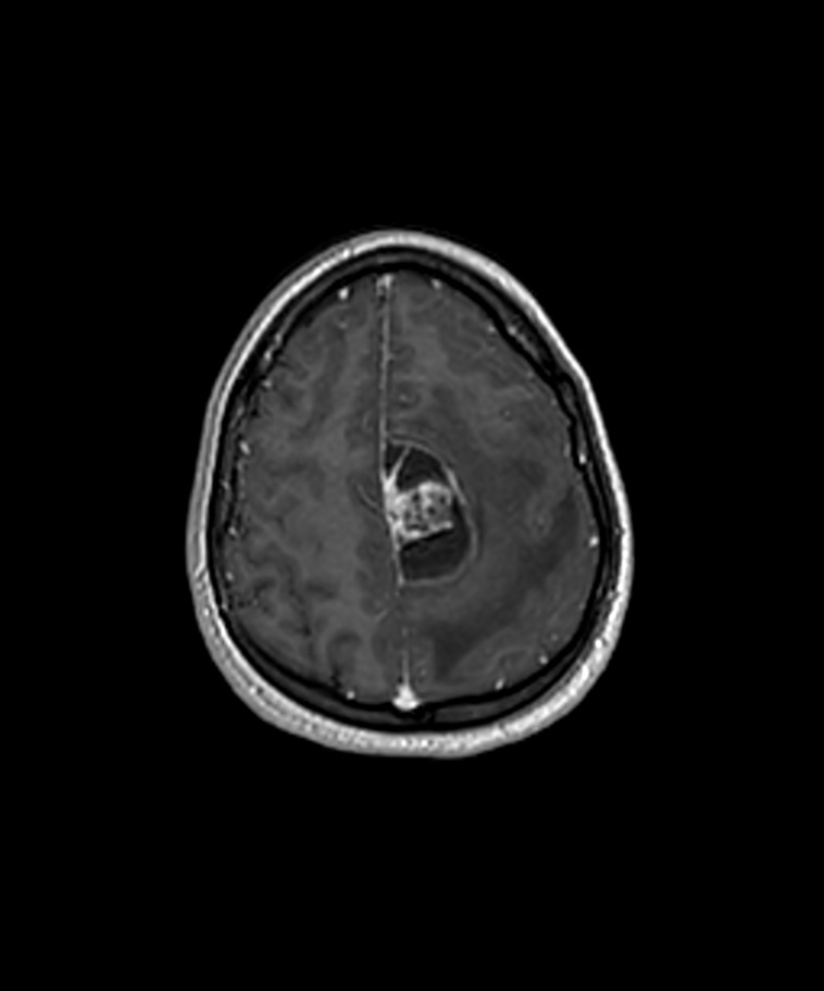 Angiomatous meningioma (Radiopaedia 79459-92577 Axial T1 C+ 3D ISO 44).jpg