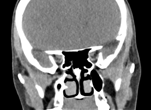 Angular dermoid cyst (Radiopaedia 88967-105790 Coronal non-contrast 42).jpg