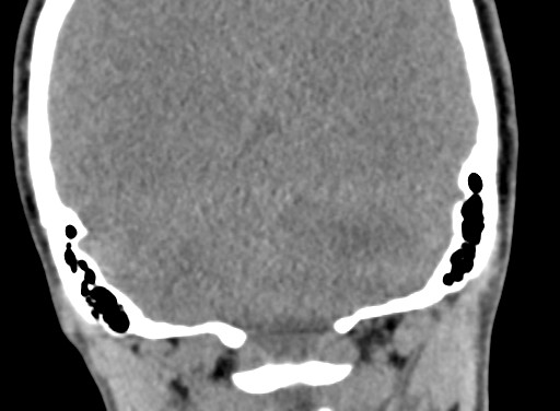 Angular dermoid cyst (Radiopaedia 88967-105790 Coronal non-contrast 96).jpg