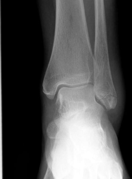 File:Ankle fracture - Weber A (Radiopaedia 12267-12567 Frontal 2).jpeg