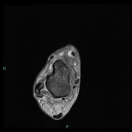 Ankle ganglion cyst (Radiopaedia 62809-71162 Axial Gradient Echo 52).jpg