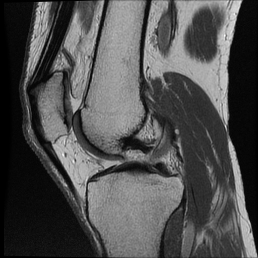 File:Anomalous insertion of the medial meniscus (Radiopaedia 77559-89721 Sagittal PD 31).jpg