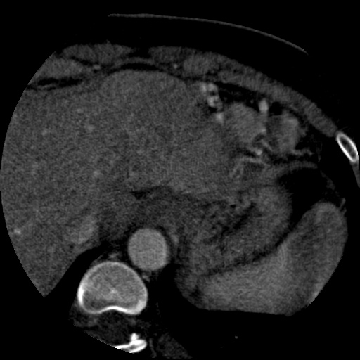 File:Anomalous left coronary artery from the pulmonary artery (ALCAPA) (Radiopaedia 40884-43586 A 85).jpg