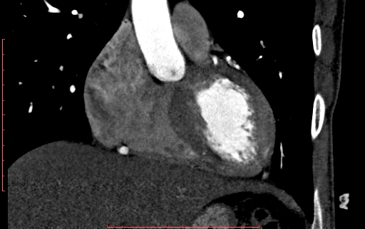 Anomalous left coronary artery from the pulmonary artery (ALCAPA) (Radiopaedia 70148-80181 B 113).jpg