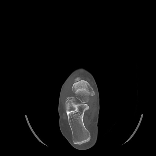 File:Anterior calcaneal process fracture (Radiopaedia 82590-96762 Axial bone window 22).jpg