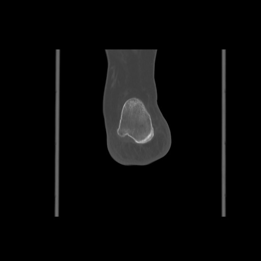 File:Anterior calcaneal process fracture (Radiopaedia 82590-96762 Coronal bone window 69).jpg